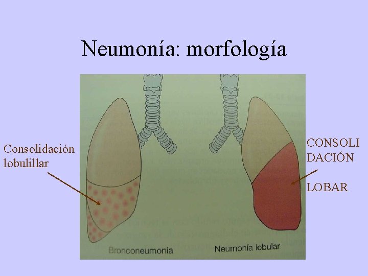 Neumonía: morfología Consolidación lobulillar CONSOLI DACIÓN LOBAR 