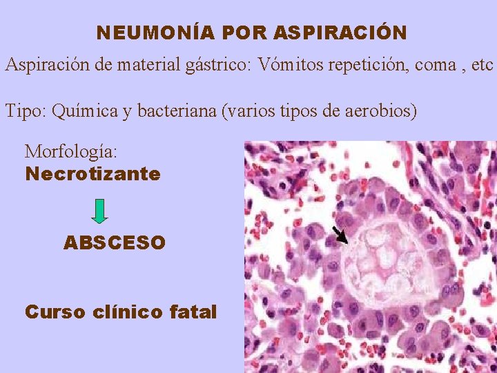 NEUMONÍA POR ASPIRACIÓN Aspiración de material gástrico: Vómitos repetición, coma , etc Tipo: Química