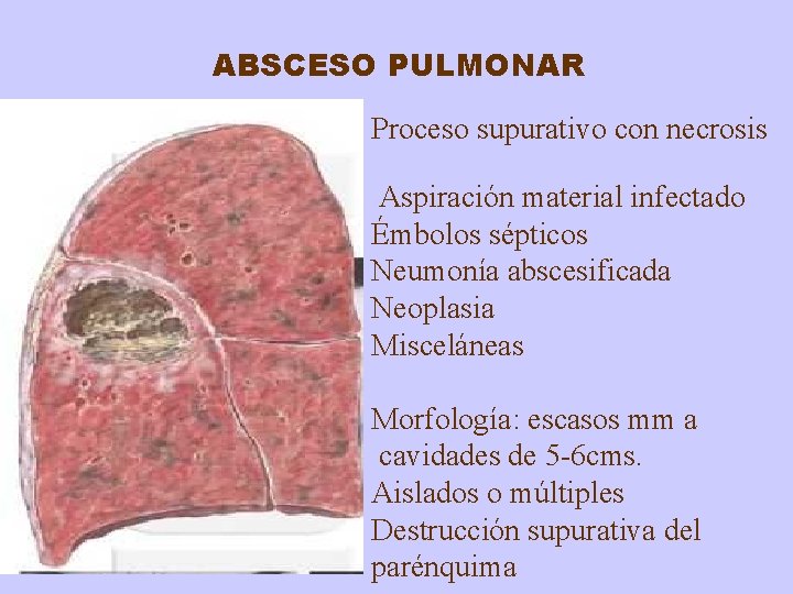 ABSCESO PULMONAR Proceso supurativo con necrosis Aspiración material infectado Émbolos sépticos Neumonía abscesificada Neoplasia