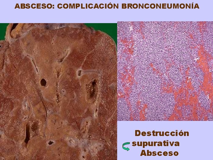 ABSCESO: COMPLICACIÓN BRONCONEUMONÍA Destrucción supurativa Absceso 