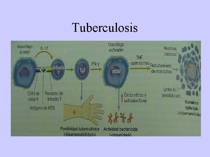 Tuberculosis 