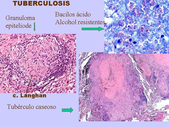 TUBERCULOSIS Granuloma epiteliode Bacilos ácido Alcohol resistentes c. Langhan Tubérculo caseoso 