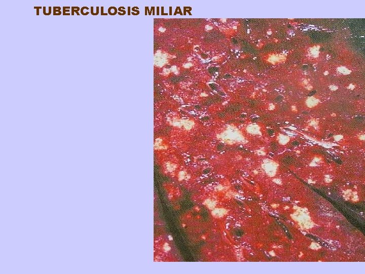 TUBERCULOSIS MILIAR 
