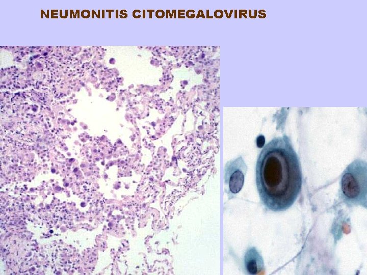 NEUMONITIS CITOMEGALOVIRUS 