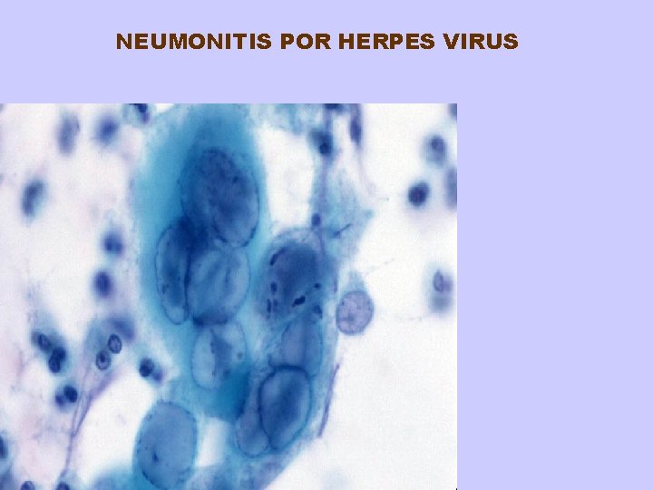 NEUMONITIS POR HERPES VIRUS 