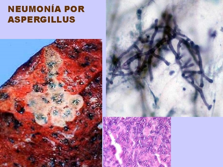 NEUMONÍA POR ASPERGILLUS 