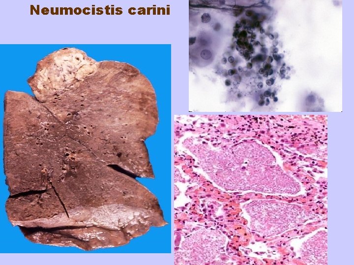 Neumocistis carini 