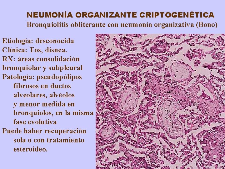 NEUMONÍA ORGANIZANTE CRIPTOGENÉTICA Bronquiolitis obliterante con neumonía organizativa (Bono) Etiología: desconocida Clínica: Tos, disnea.