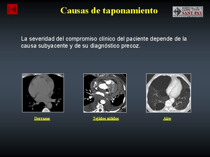 Causas de taponamiento La severidad del compromiso clínico del paciente depende de la causa