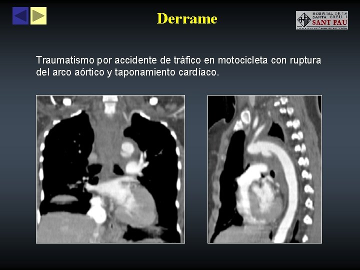 Derrame Traumatismo por accidente de tráfico en motocicleta con ruptura del arco aórtico y