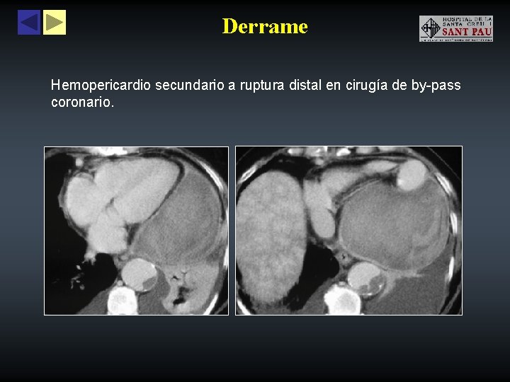 Derrame Hemopericardio secundario a ruptura distal en cirugía de by-pass coronario. 