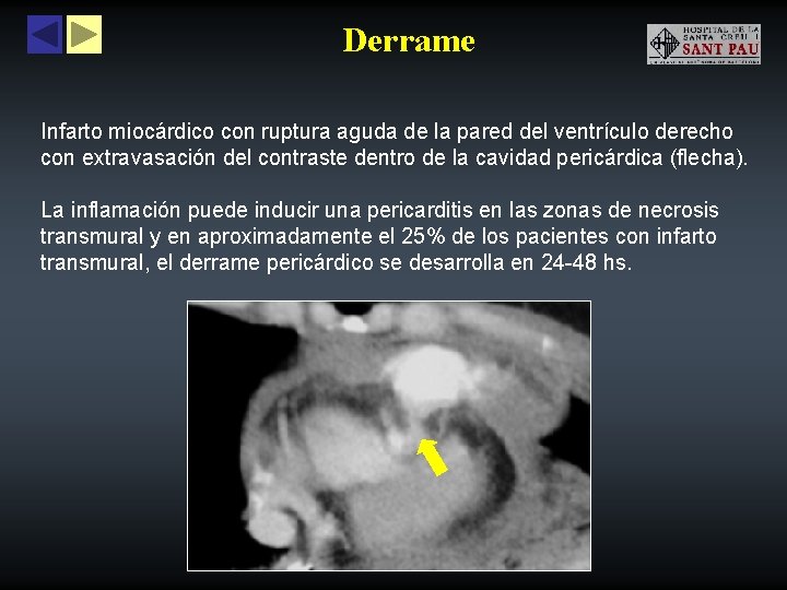 Derrame Infarto miocárdico con ruptura aguda de la pared del ventrículo derecho con extravasación