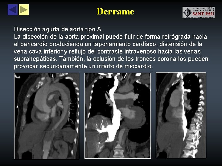 Derrame Disección aguda de aorta tipo A. La disección de la aorta proximal puede