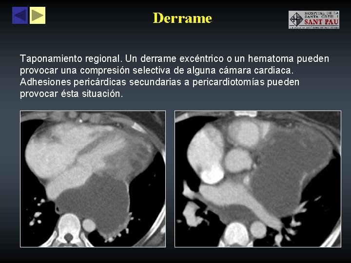 Derrame Taponamiento regional. Un derrame excéntrico o un hematoma pueden provocar una compresión selectiva
