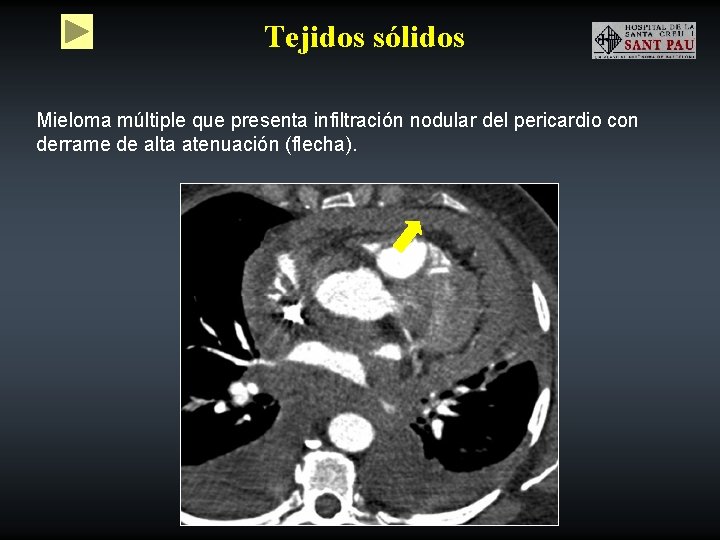 Tejidos sólidos Mieloma múltiple que presenta infiltración nodular del pericardio con derrame de alta
