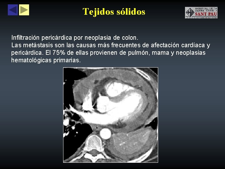 Tejidos sólidos Infiltración pericárdica por neoplasia de colon. Las metástasis son las causas más