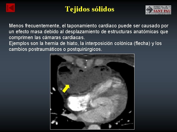 Tejidos sólidos Menos frecuentemente, el taponamiento cardiaco puede ser causado por un efecto masa
