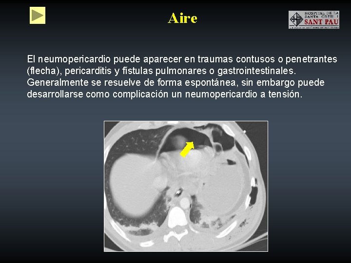 Aire El neumopericardio puede aparecer en traumas contusos o penetrantes (flecha), pericarditis y fístulas