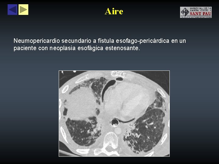 Aire Neumopericardio secundario a fístula esofago-pericárdica en un paciente con neoplasia esofágica estenosante. 