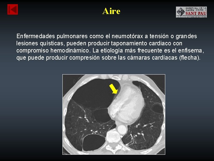 Aire Enfermedades pulmonares como el neumotórax a tensión o grandes lesiones quísticas, pueden producir
