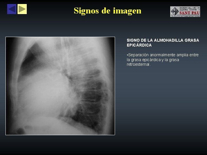 Signos de imagen SIGNO DE LA ALMOHADILLA GRASA EPICÁRDICA • Separación anormalmente amplia entre