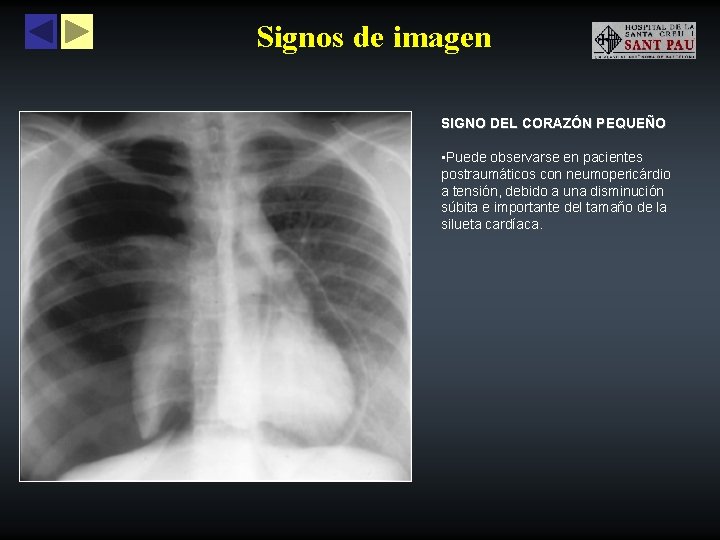 Signos de imagen SIGNO DEL CORAZÓN PEQUEÑO • Puede observarse en pacientes postraumáticos con