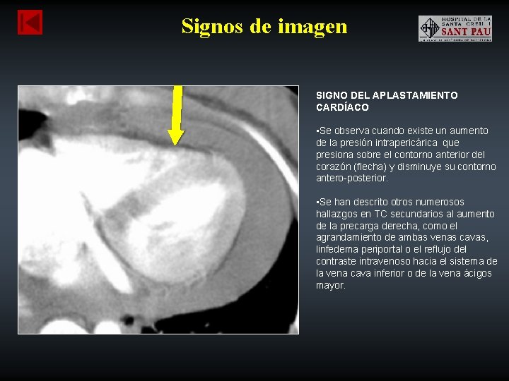 Signos de imagen SIGNO DEL APLASTAMIENTO CARDÍACO • Se observa cuando existe un aumento