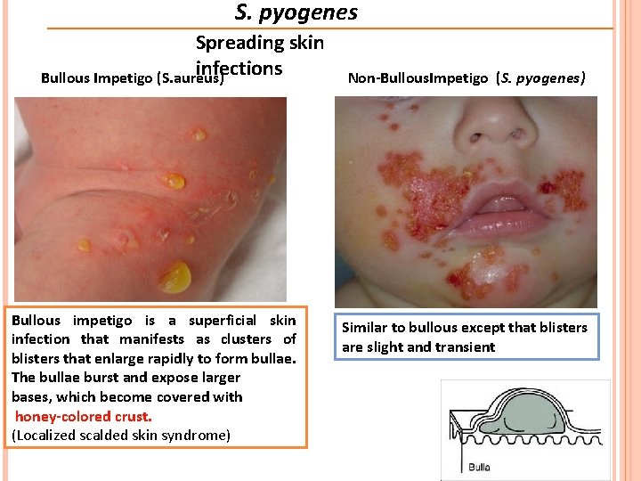 S. pyogenes Spreading skin infections Bullous Impetigo (S. aureus) Bullous impetigo is a superficial