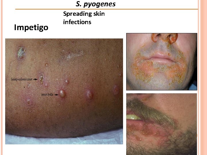 S. pyogenes Impetigo Spreading skin infections 