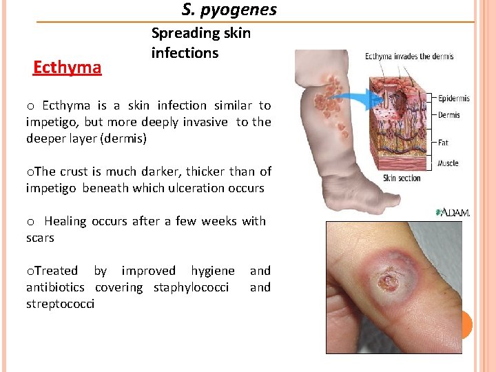 S. pyogenes Ecthyma Spreading skin infections o Ecthyma is a skin infection similar to