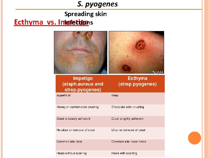 S. pyogenes Spreading skin infections Ecthyma vs. Impetigo 