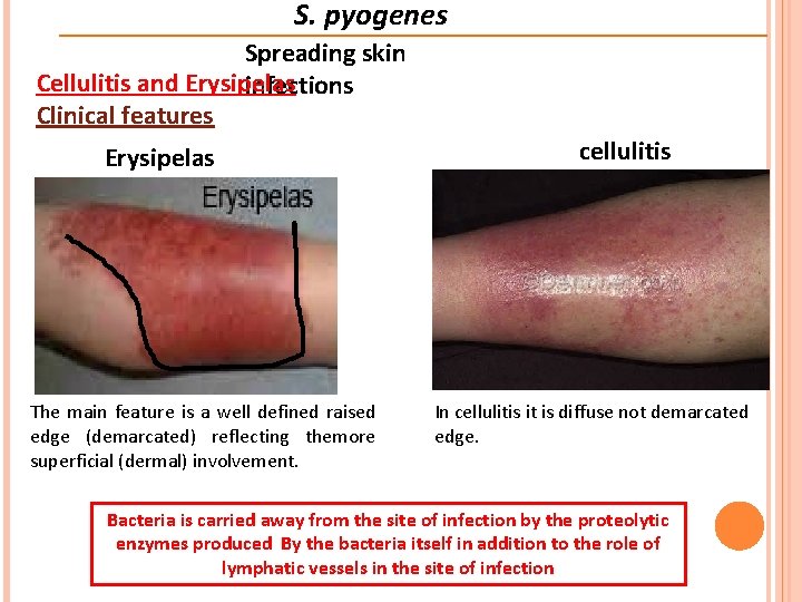 S. pyogenes Spreading skin Cellulitis and Erysipelas infections Clinical features Erysipelas The main feature