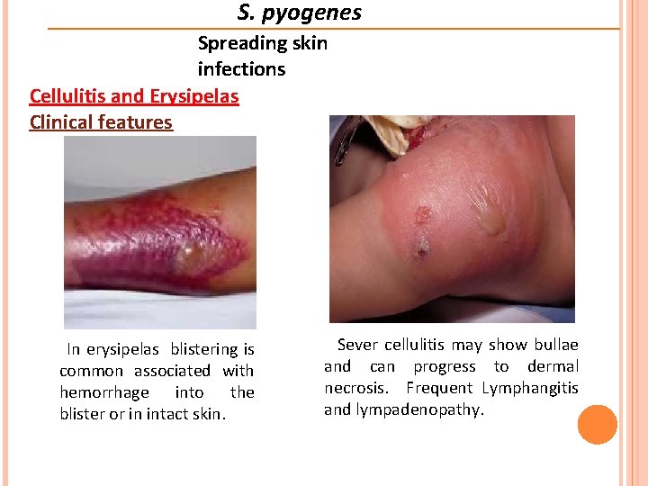 S. pyogenes Spreading skin infections Cellulitis and Erysipelas Clinical features In erysipelas blistering is
