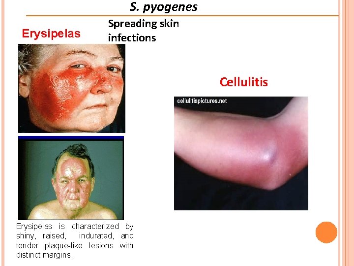 S. pyogenes Erysipelas Spreading skin infections Cellulitis Erysipelas is characterized by shiny, raised, indurated, S. pyogenes Erysipelas Spreading skin infections Cellulitis Erysipelas is characterized by shiny, raised, indurated,