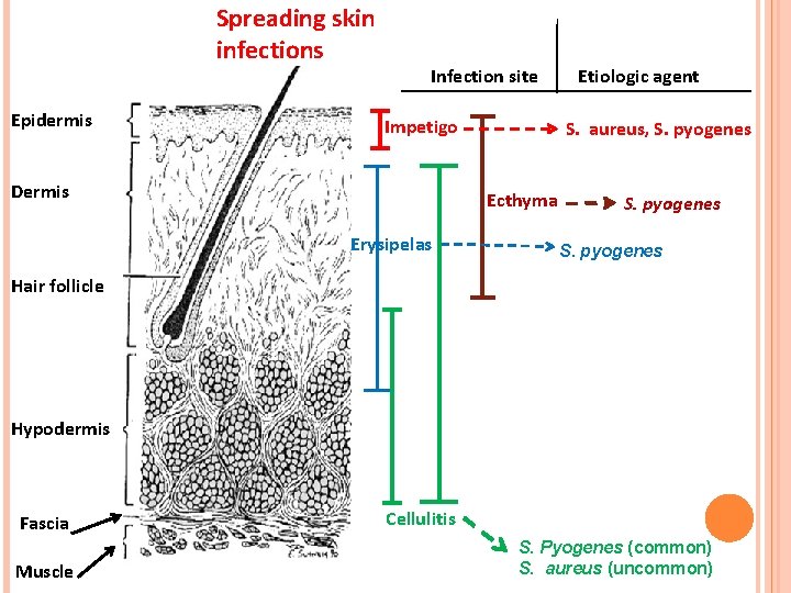 Spreading skin infections Epidermis Infection site Impetigo Dermis S. aureus, S. pyogenes Ecthyma Erysipelas