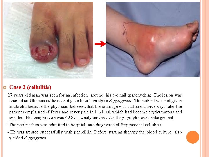  Case 2 (cellulitis) 27 years old man was seen for an infection around