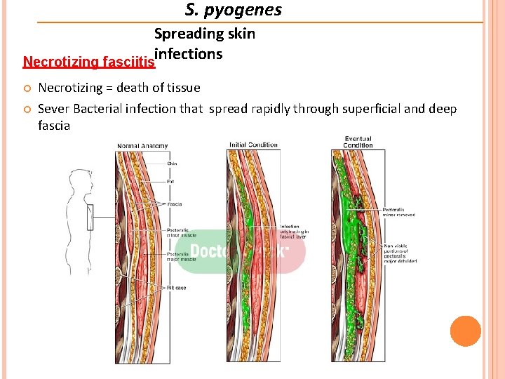 S. pyogenes Spreading skin infections Necrotizing fasciitis Necrotizing = death of tissue Sever Bacterial