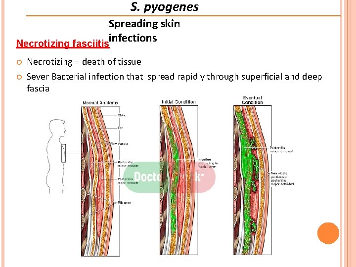 S. pyogenes Spreading skin infections Necrotizing fasciitis Necrotizing = death of tissue Sever Bacterial S. pyogenes Spreading skin infections Necrotizing fasciitis Necrotizing = death of tissue Sever Bacterial