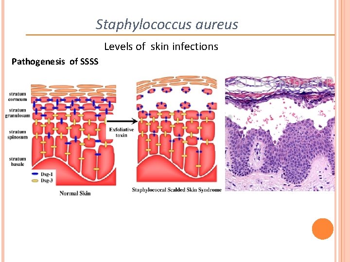 Staphylococcus aureus Levels of skin infections Pathogenesis of SSSS 