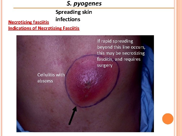 S. pyogenes Spreading skin infections Necrotizing fasciitis Indications of Necrotizing Fasciitis If rapid spreading