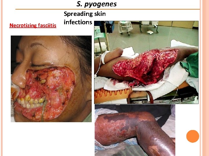 S. pyogenes Necrotizing fasciitis Spreading skin infections 