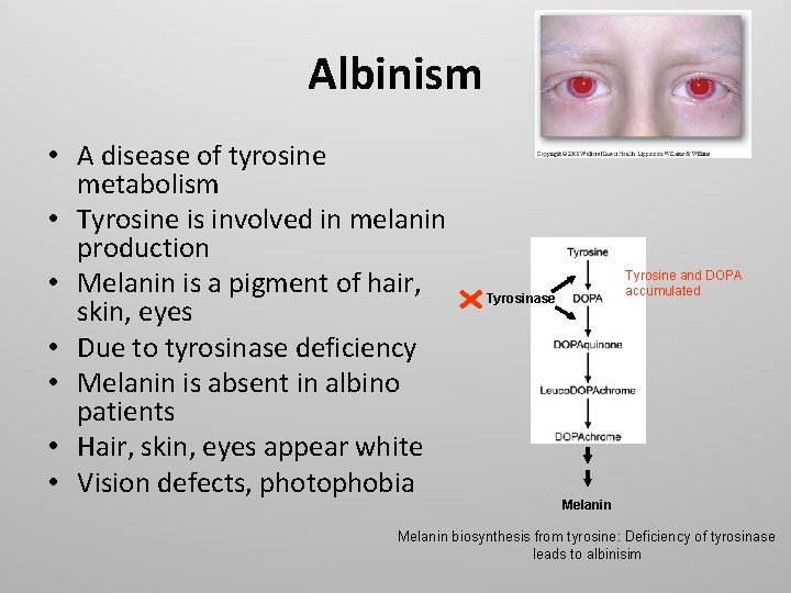 Albinism • A disease of tyrosine metabolism • Tyrosine is involved in melanin production