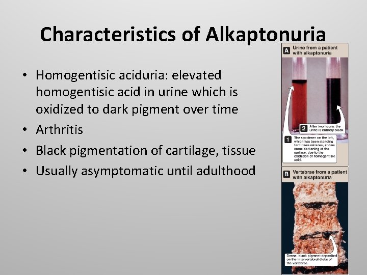 Characteristics of Alkaptonuria • Homogentisic aciduria: elevated homogentisic acid in urine which is oxidized