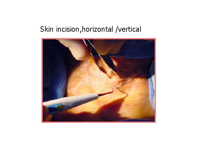 Skin incision, horizontal /vertical 