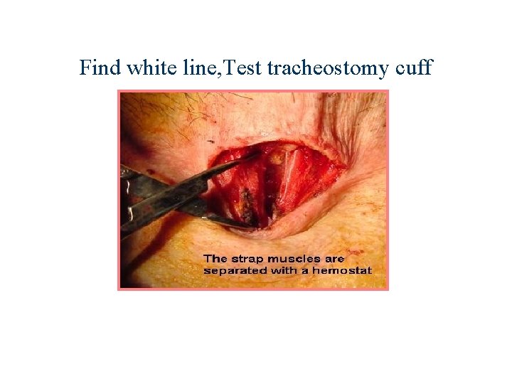Find white line, Test tracheostomy cuff 