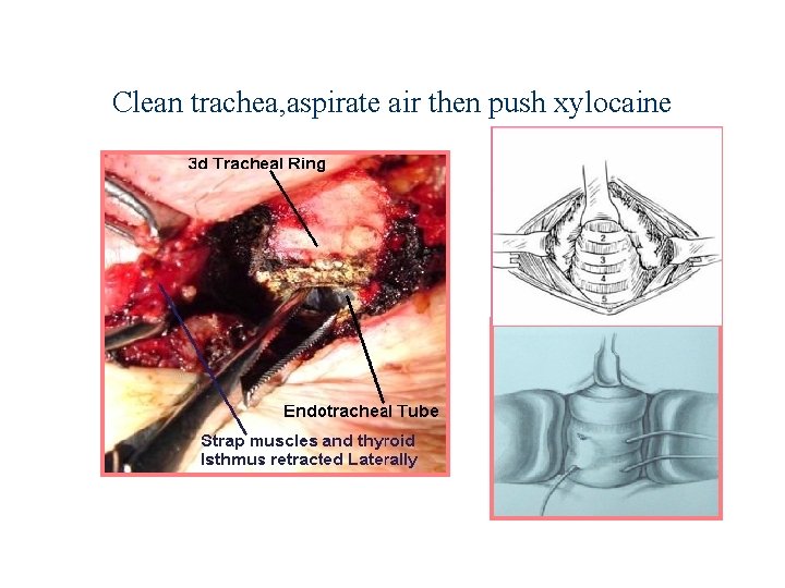 Clean trachea, aspirate air then push xylocaine 