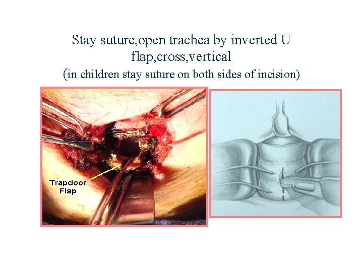 Stay suture, open trachea by inverted U flap, cross, vertical (in children stay suture