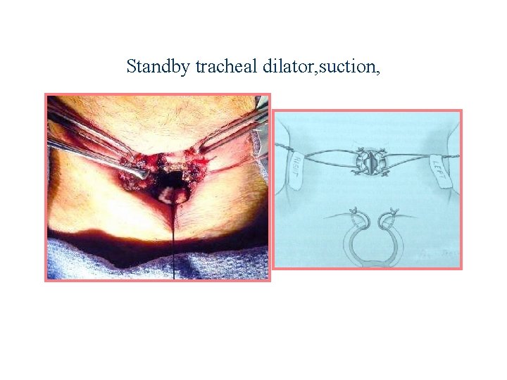Standby tracheal dilator, suction, 