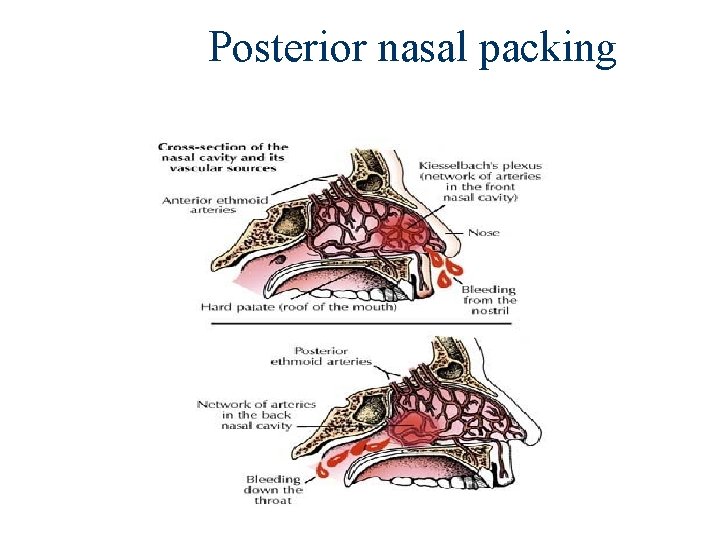 Posterior nasal packing 