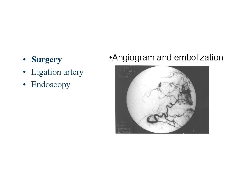  • Surgery • Ligation artery • Endoscopy • Angiogram and embolization 